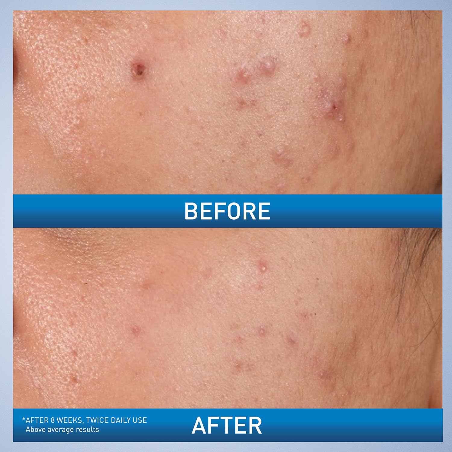CeraVe Salicylic Acid Acne Control Gel 40ml before and after results comparison