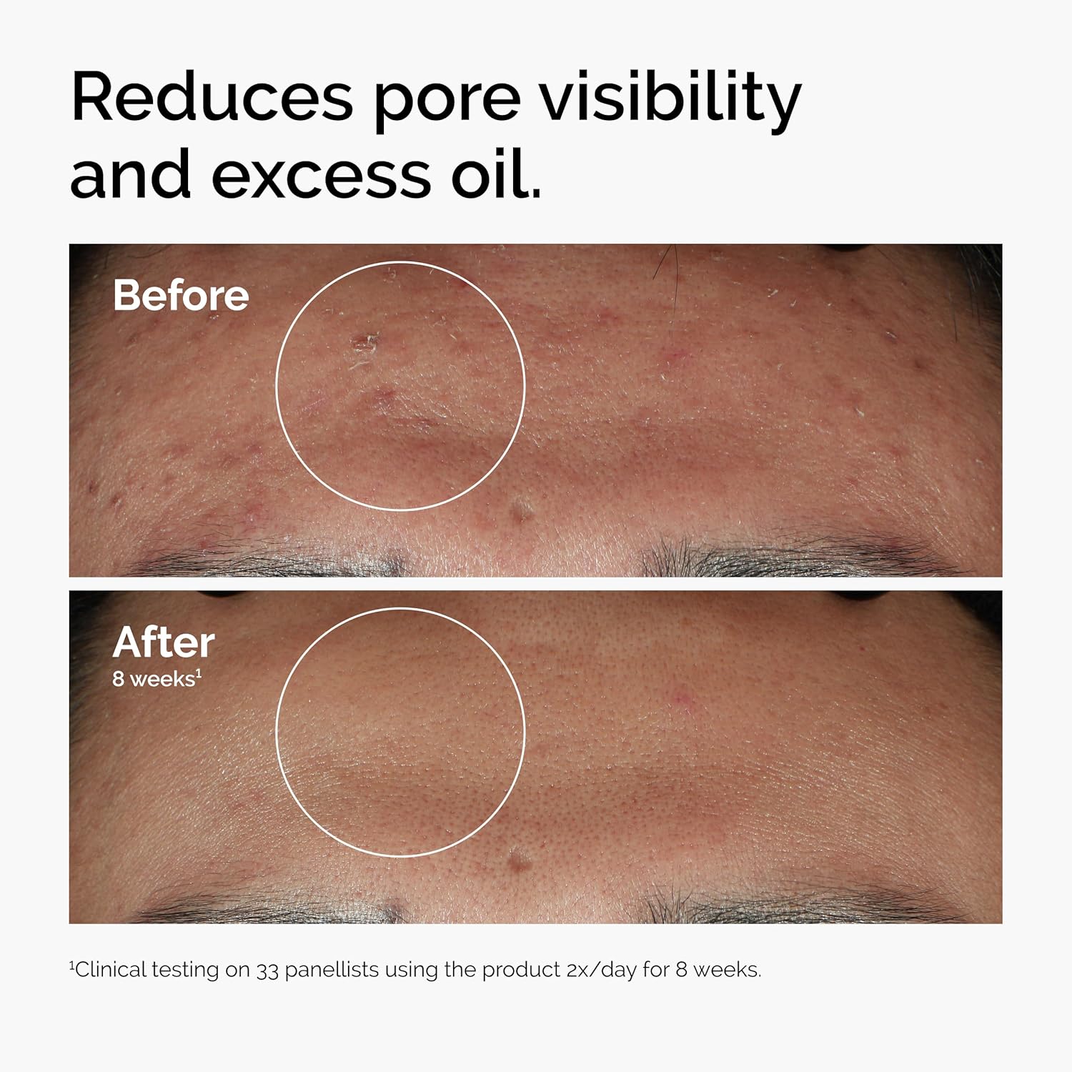 The Ordinary Niacinamide 10% + Zinc 1% smoothing serum for blemish-prone skin